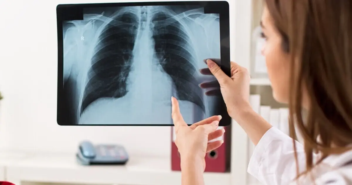 Doctor pointing at Xray of lungs
