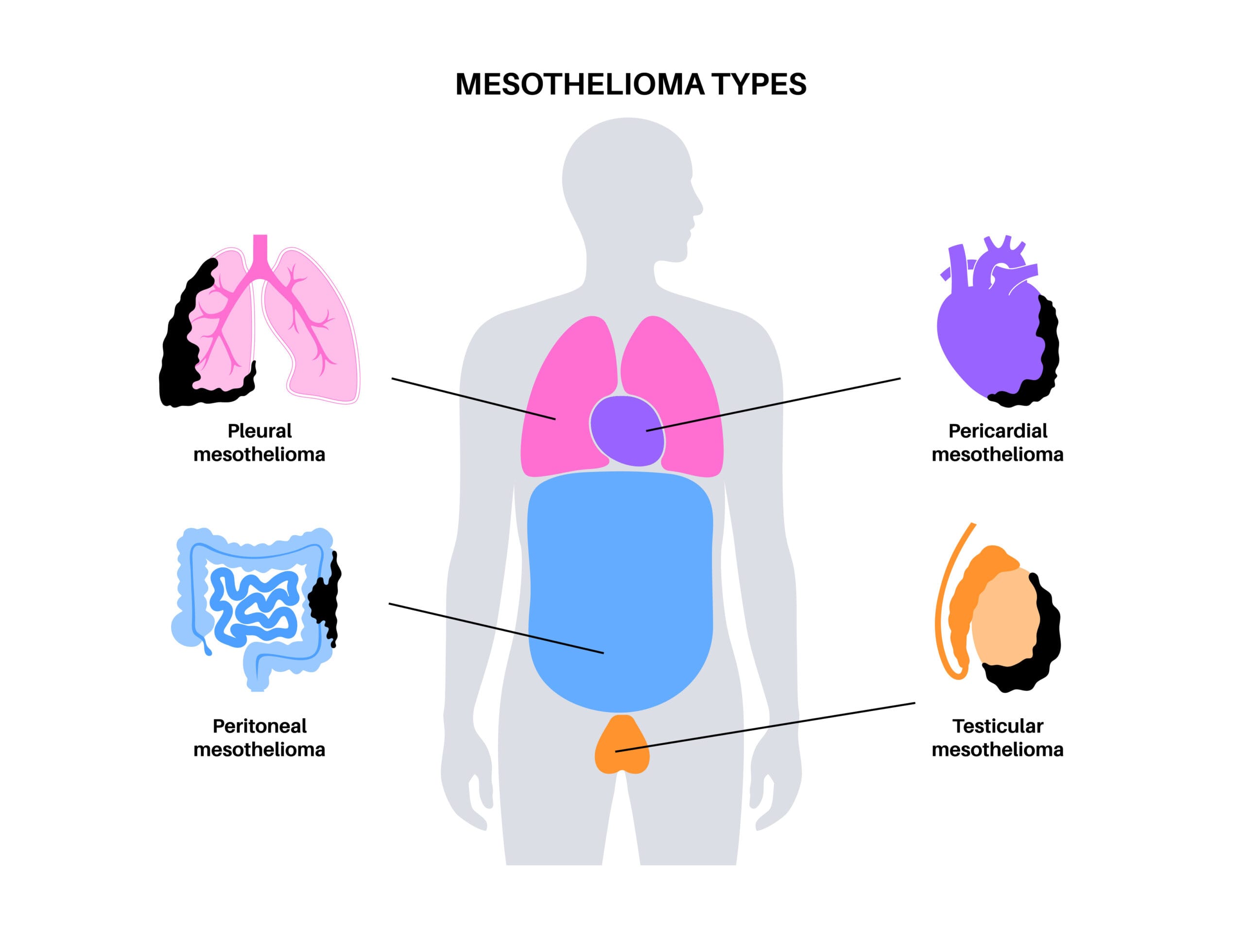 Types of Mesothelioma: Identifying Your Condition and Legal Steps to Take